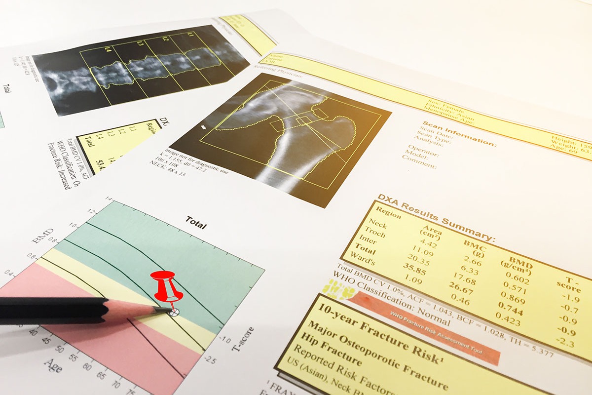 A printed DXA bone density report showing hip and spine scans, a T-score chart and a 10-year fracture risk summary